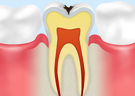 Step02　C1（エナメル質の虫歯）